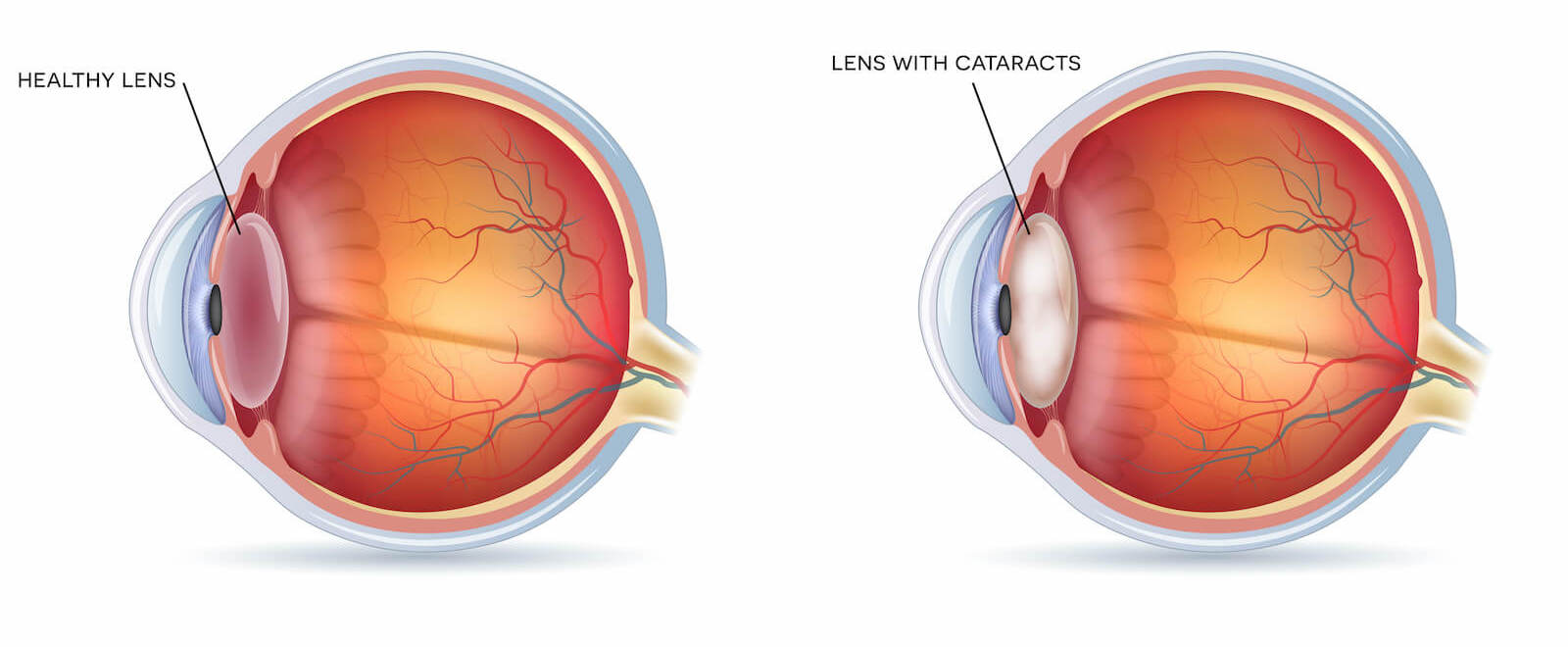 Diagram showing a healthy lens vs a lens with cataracts.