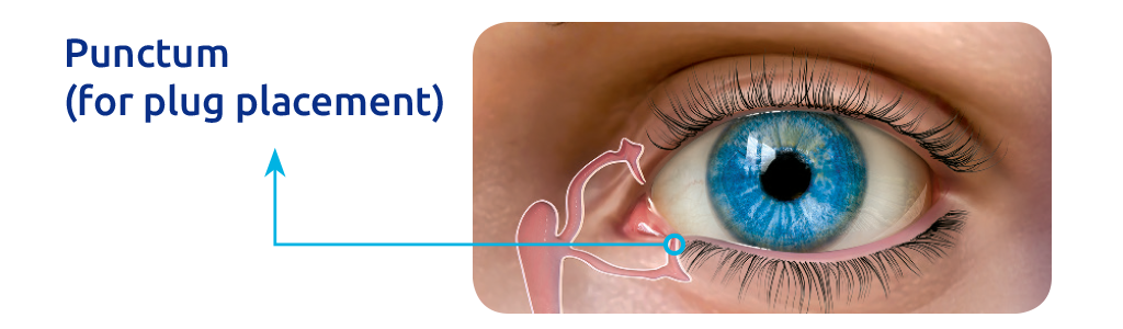 Diagram showing placement of punctal plug.